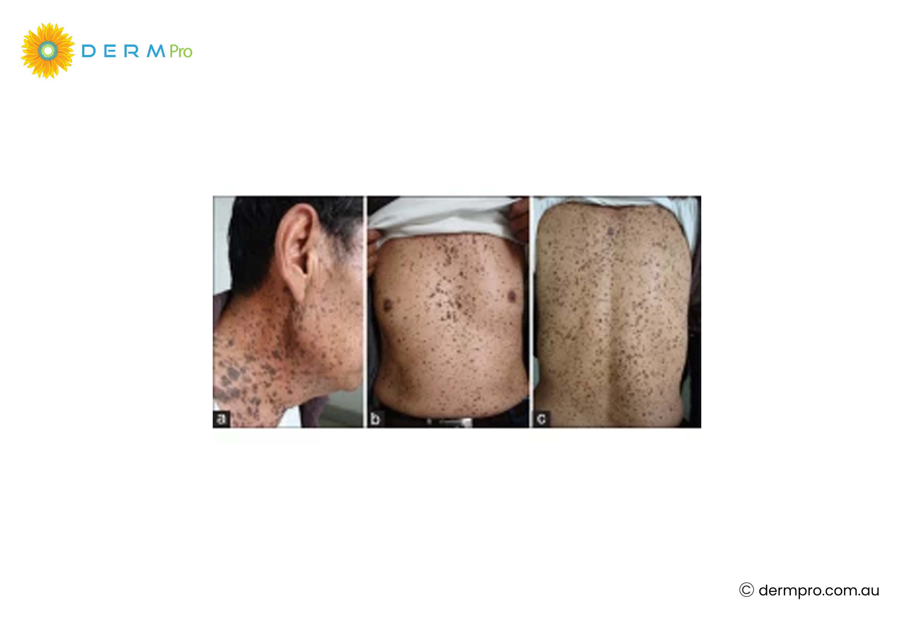Seborrheic Keratosis image